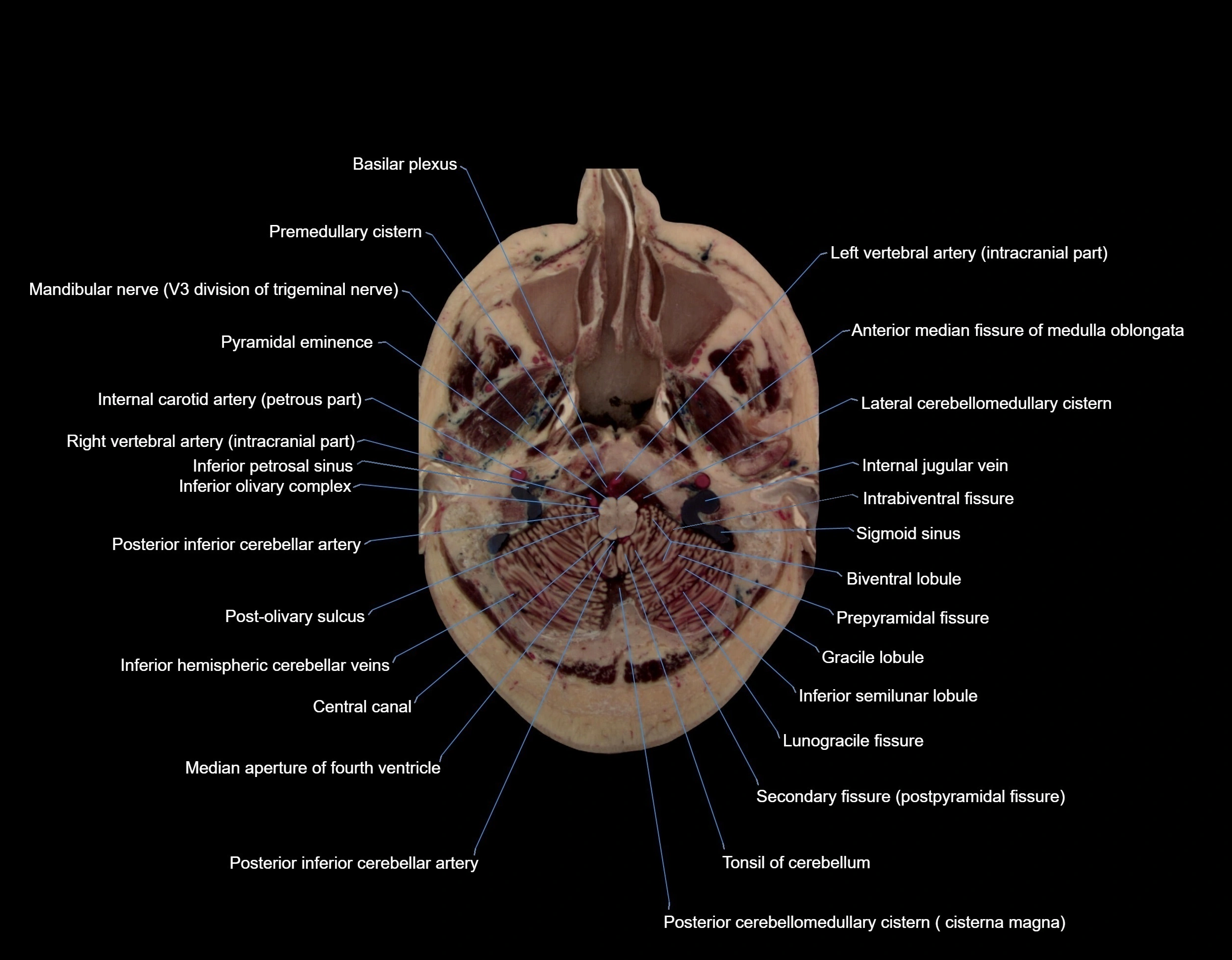 MRI Brain axial cross sectional radiology anatomy 3T image  -img-00007.webp